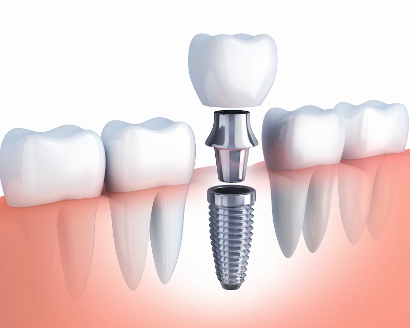 インプラント治療の流れ 人工歯の装着
